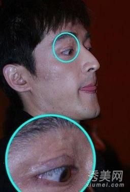 明星们脸上疤痕,见证荣耀与挑战的印记